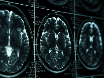 Neuraltus Reports NP001 Study Did Not Meet Primary, Secondary Endpoints