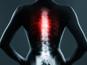Pfenex Announces Positive Top-Line PF708 Study Results in Osteoporosis Patients