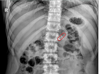 RaniPill™ capsule outlined in red, moving from the stomach to the intestines