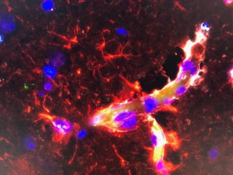Damaged blood vessel in the brain (Credit for image: Courtesy of Dr. Merav Shamir)