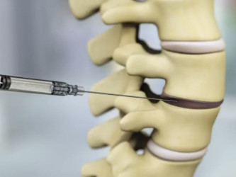 During treatment, a single dose of IDCT is injected into the painful disc percutaneously.