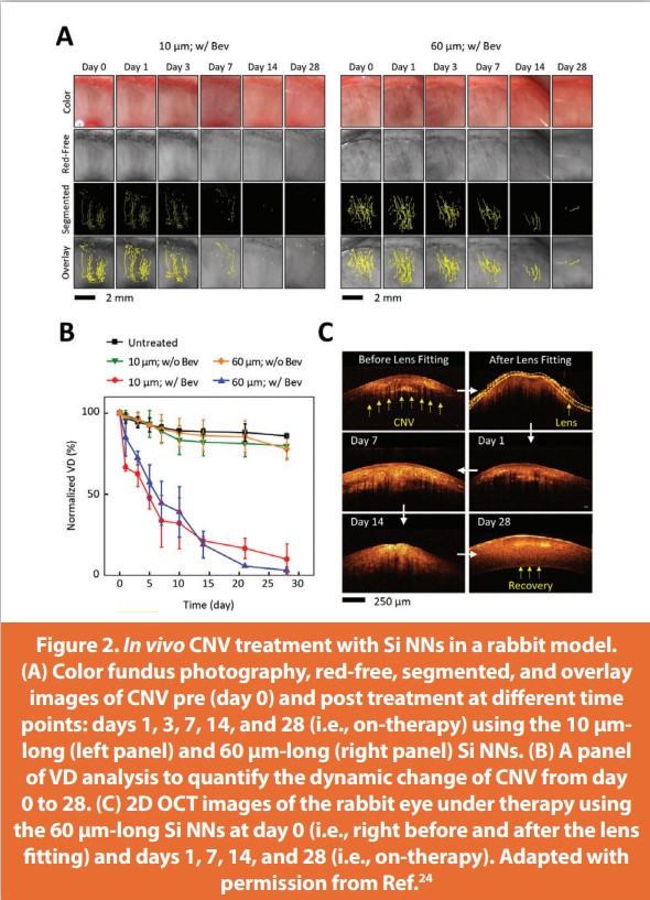 Figure 2. In vivo CNV treatment with Si NNs in a rabbit model. (A) Color fundus photography, red-free, segmented, and overlay images of CNV pre (day 0) and post treatment at diff erent time points: days 1, 3, 7, 14, and 28 (i.e., on-therapy) using the 10 μm-long (left panel) and 60 μm-long (right panel) Si NNs. (B) A panel of VD analysis to quantify the dynamic change of CNV from day 0 to 28. (C) 2D OCT images of the rabbit eye under therapy using the 60 μm-long Si NNs at day 0 (i.e., right before and after the lens fitting) and days 1, 7, 14, and 28 (i.e., on-therapy). Adapted with permission from Ref.24