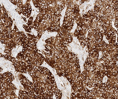 Ventana PD-L1 (SP263) Assay staining in urothelial carcinoma