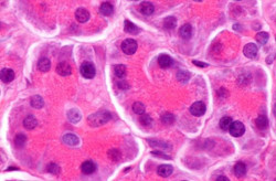 Acute Pancreatitis