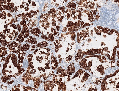 Non-small cell lung cancer tissue stained with the VENTANA ALK (D5F3) CDx Assay and OptiView DAB Detection and Amplification