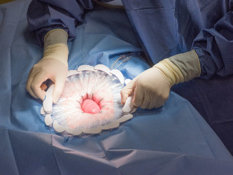 CleanCision Wound Retraction and Protection System