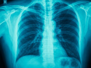 Comparative Evaluation of the Efficacy of Glycopyrronium Versus Tiotropium as an Adjunct to Formoterol Therapy in COPD: A Questionnaire-Based Investigation at a Tertiary Care Facility